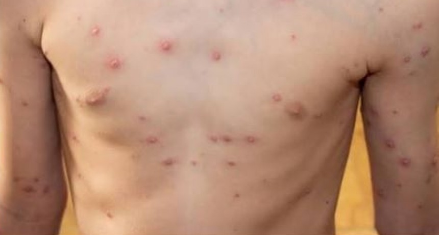 El Ministerio de Desarrollo Humano lleva adelante acciones ante la aparición de casos compatibles con varicela