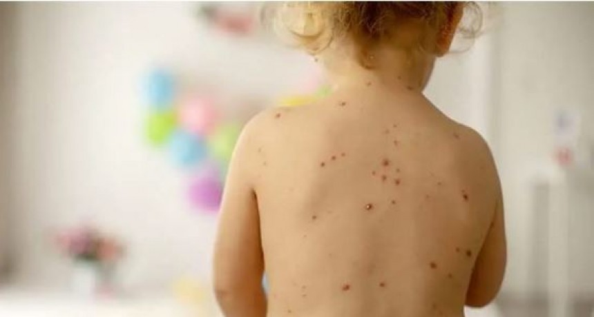 Desde el Ministerio de Desarrollo Humano hablaron de la varicela